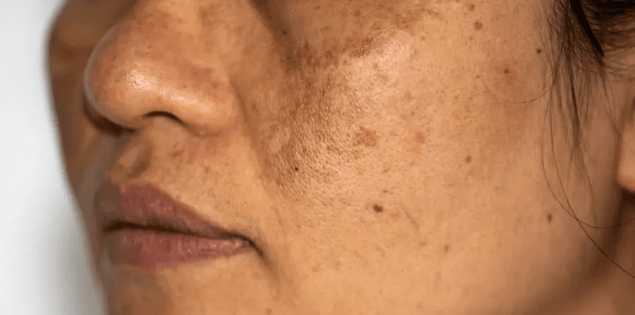 Facial Pigmentation (Other)