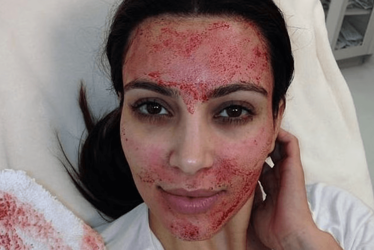 Microneedling