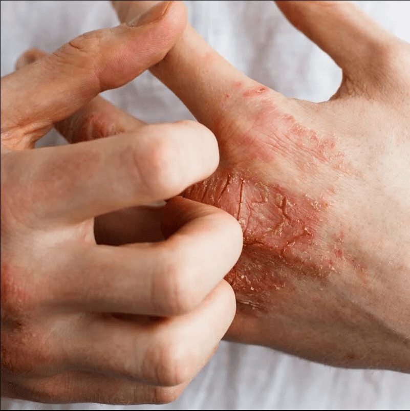 Atopic Dermatitis