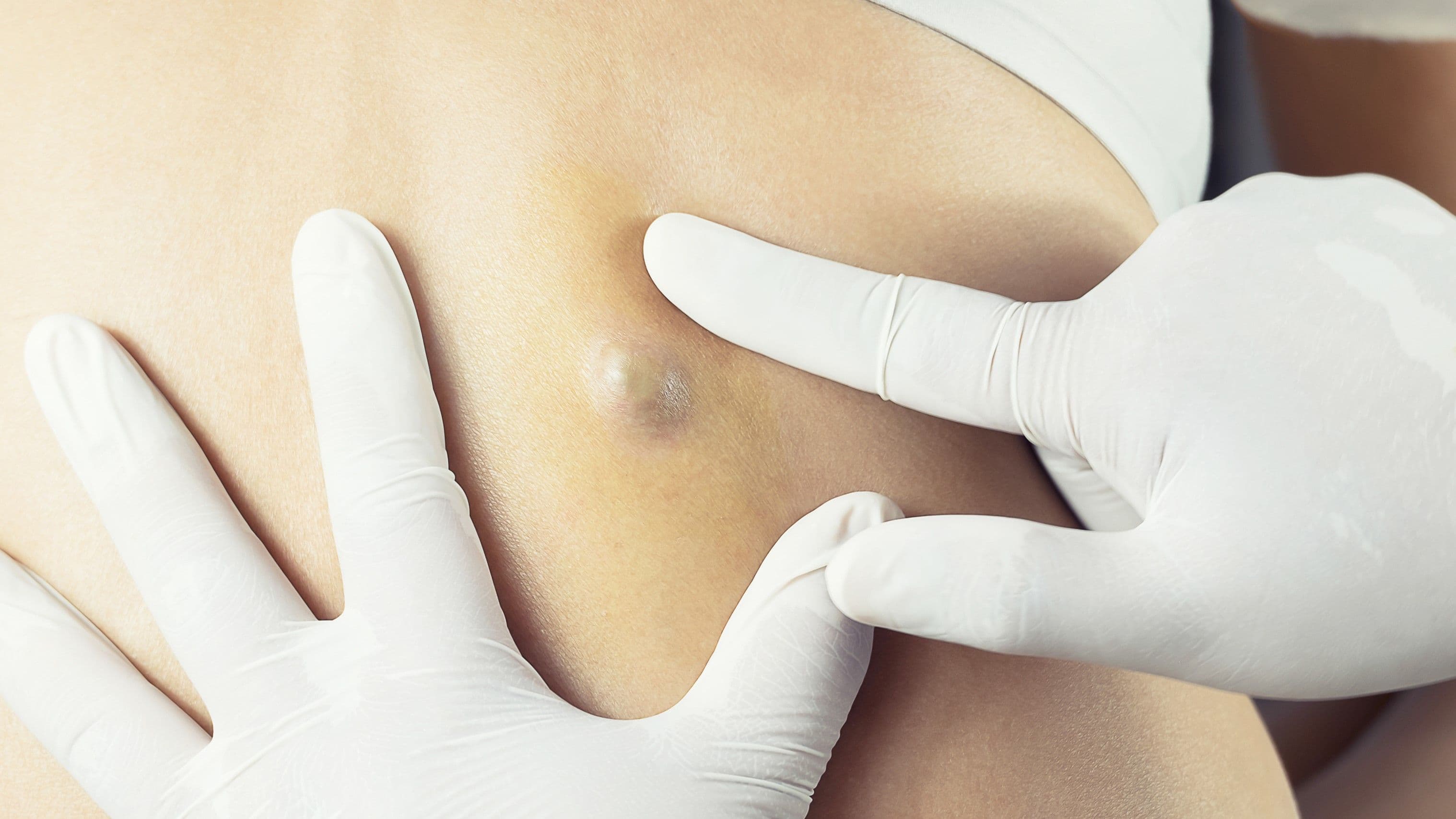 Cysts