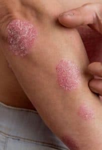 Eczema