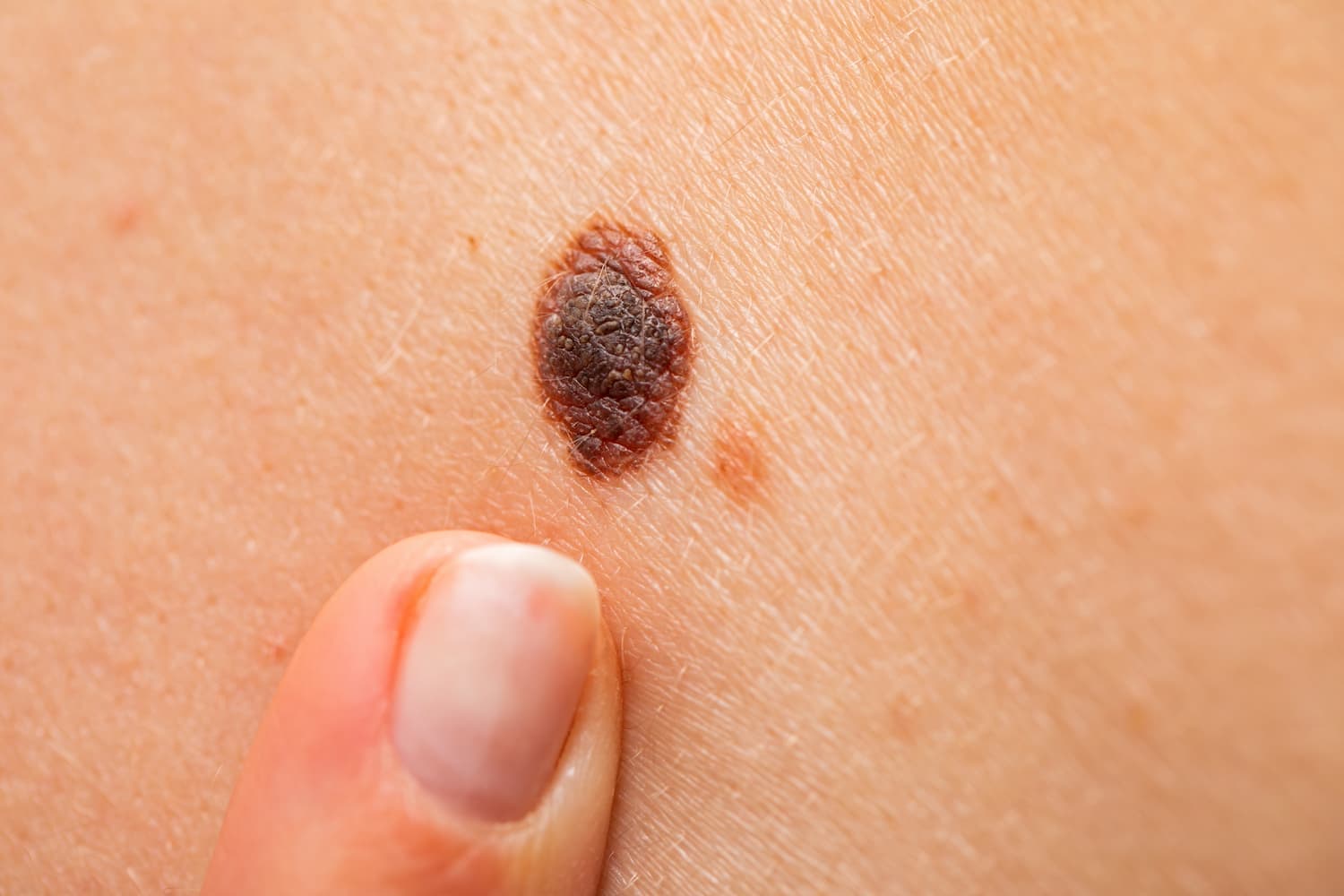 Moles