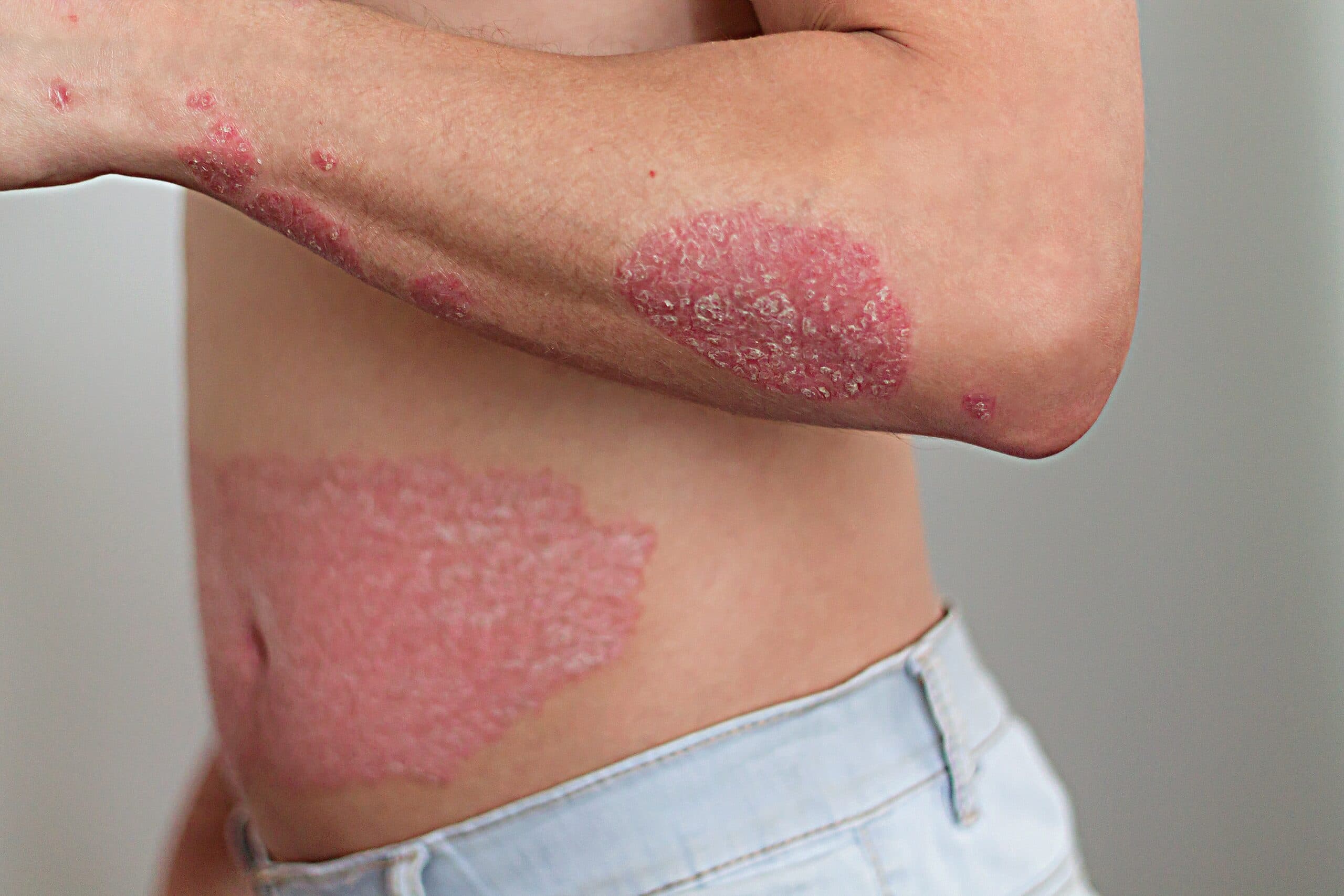 Psoriasis Treatment
