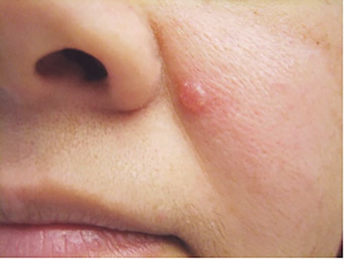 Skin Tumors & Growths