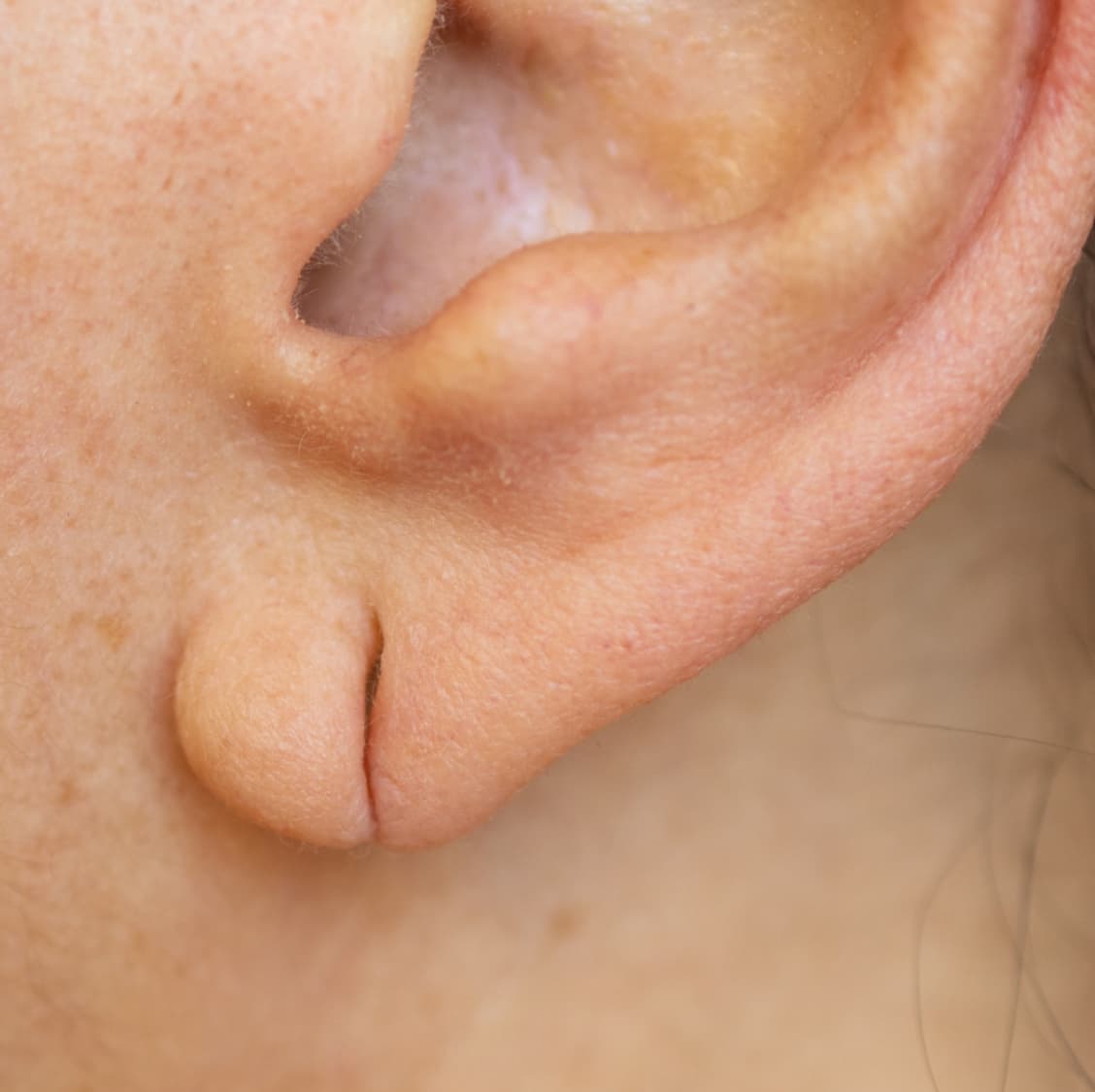Split Earlobe