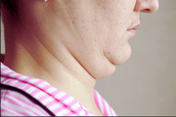 Double Chin Correction