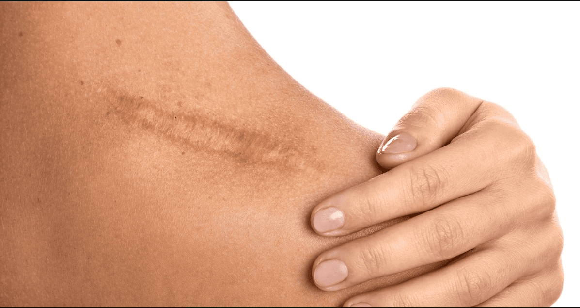 Scar Treatment