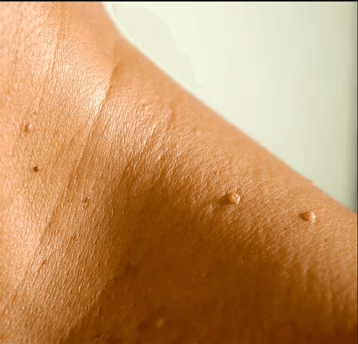Skin Tags