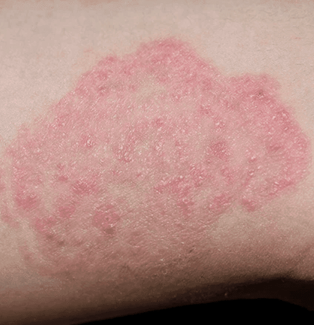 Skin Infections