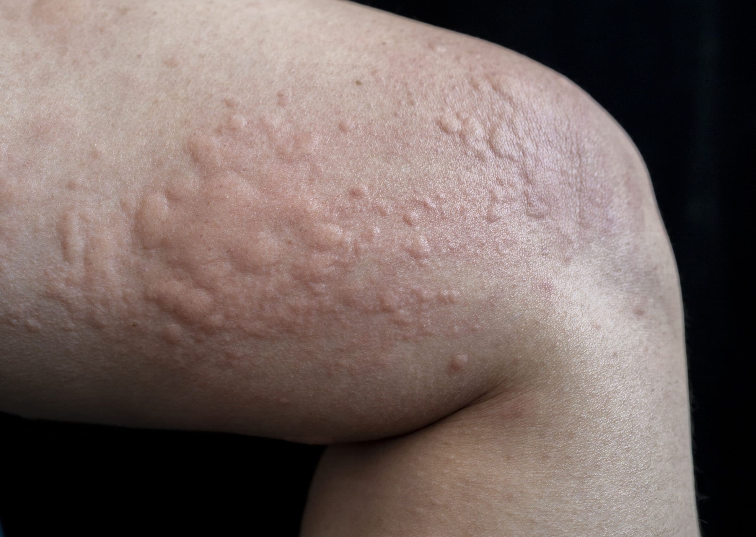 Urticaria (Hives)